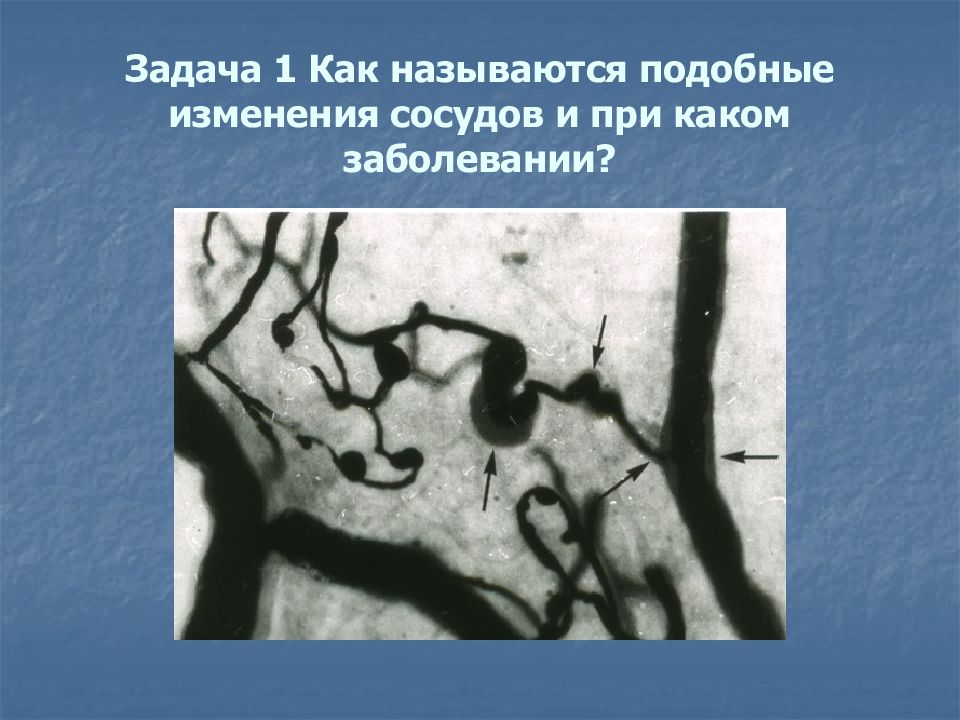 Изменения сосудов. Изменения при заболевании сосудов. Дегенеративные изменения артерий. Ретикуло подобные изменения. Рубцоврподоьные изменения.