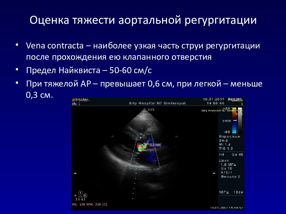 Что означает регургитация 1. Аортальная недостаточность эхокардиография. Недостаточность аортального клапана эхокардиография. Степень аортальной регургитации эхокардиография. Оценка тяжести аортальной регургитации.