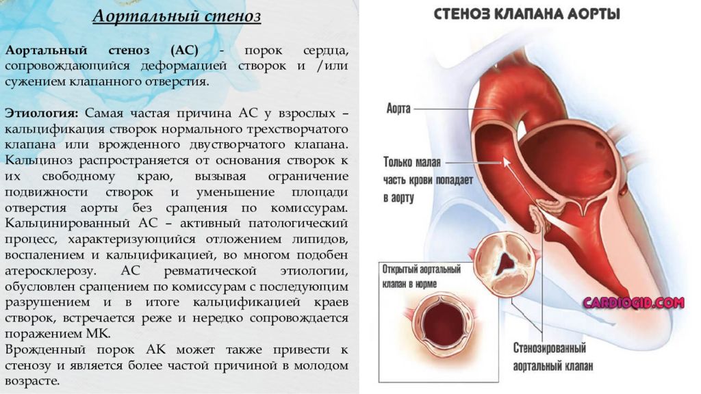 Причины порока сердца