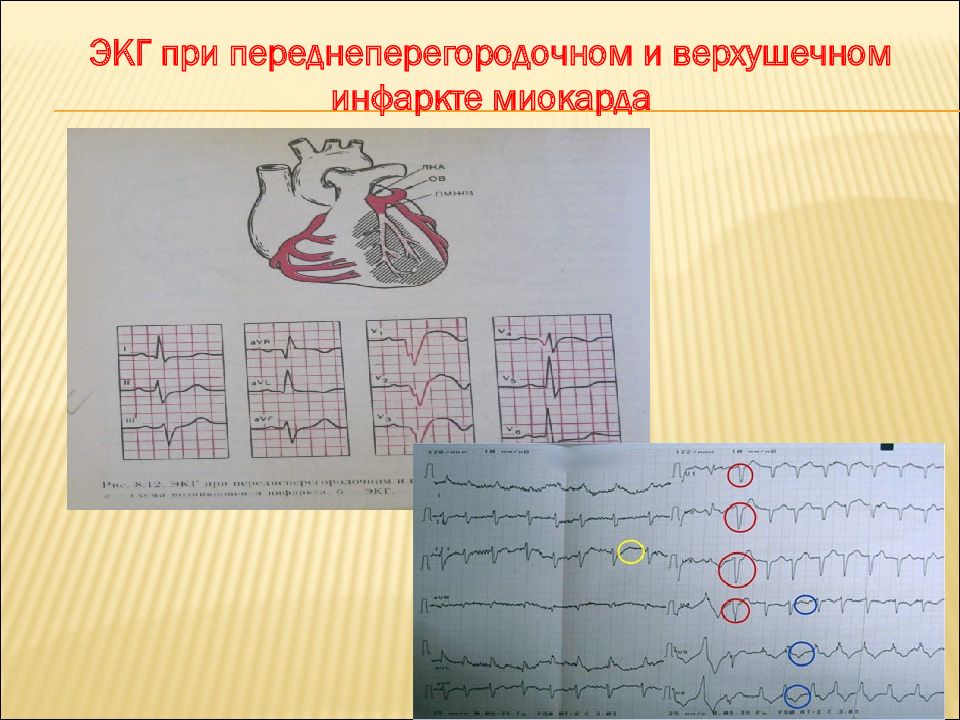 Экг презентация терапия