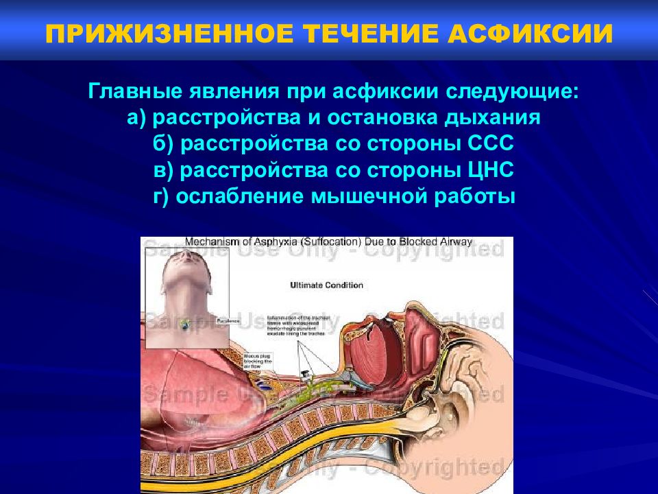 Асфиксия это простыми словами. Компрессионная асфиксия. Травматическая асфиксия. Патогенез странгуляционной асфиксии. Прижизненное течение асфиксии.