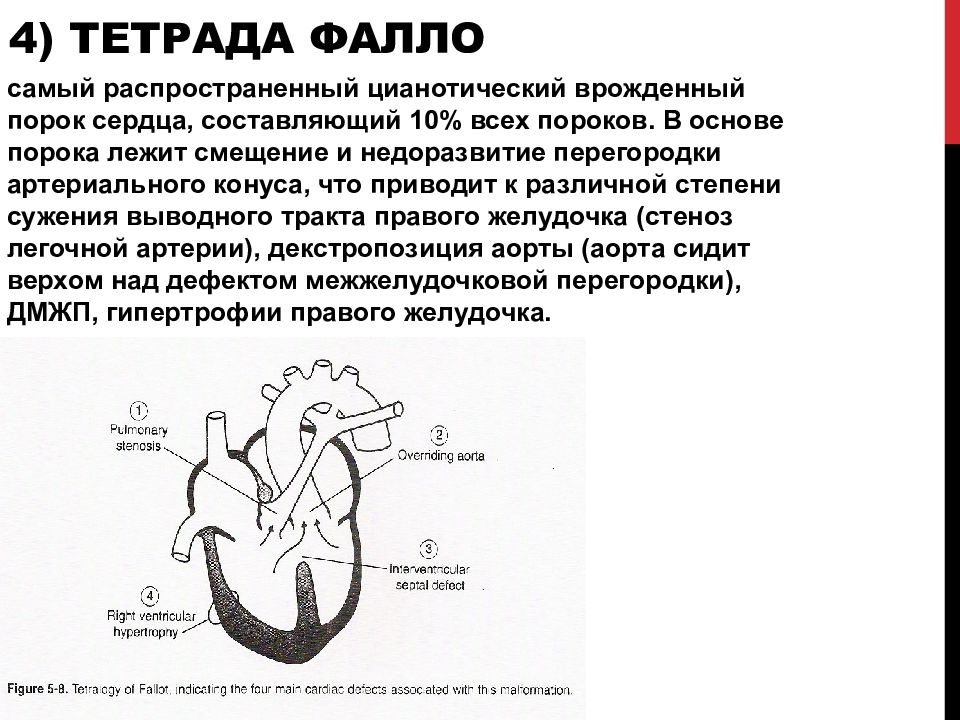 Тетрада фалло это. Врожденные пороки сердца Фалло.