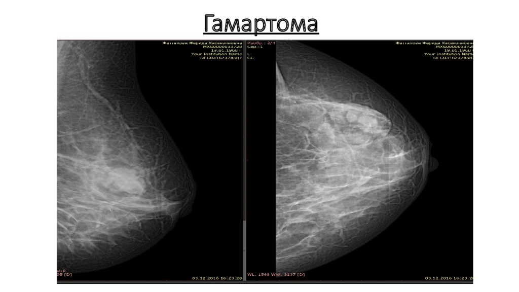 Какое ультразвуковая картина наиболее характерна для гамартомы молочной железы