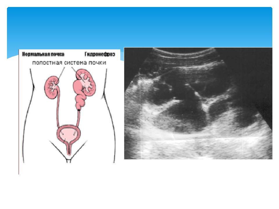 Нефроптоз справа что это у женщин
