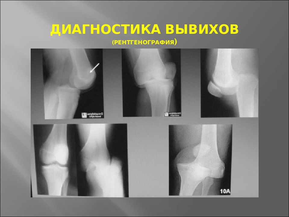 Вывих колена. Подвывих коленного сустава рентген. Вывих коленного сустава рентген.