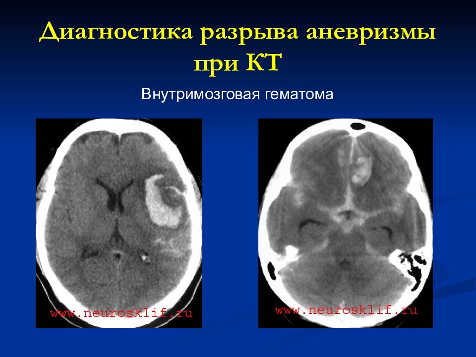 Симптомы разрыва аневризмы. Разрыв аневризма головного мозга. Обызвествленная аневризма головного мозга кт.