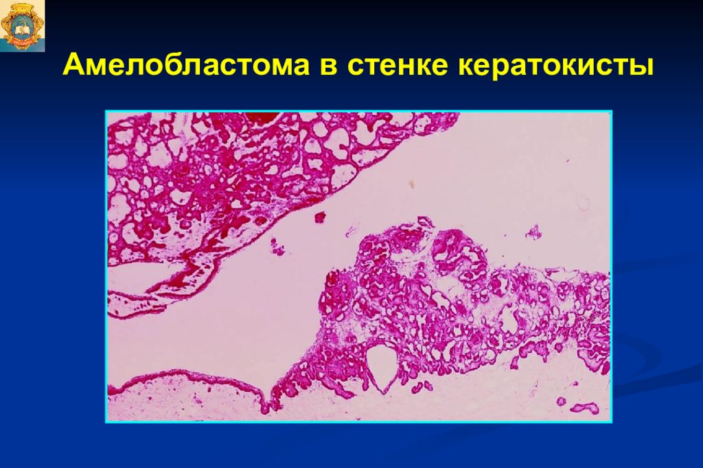 Опухоли опухолеподобные поражения и кисты кожи лица презентация