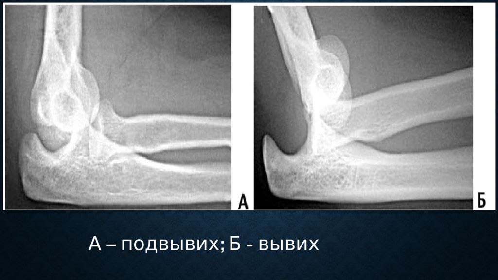 Вывих и подвывих схема