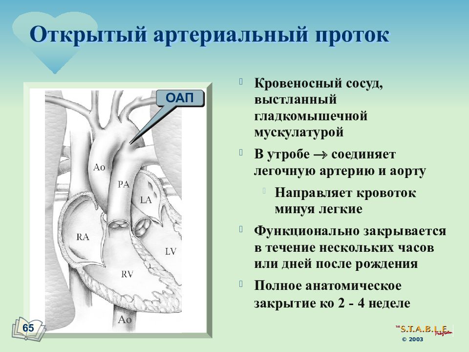 Открытый артериальный проток. Гемодинамика при ОАП. Анатомическое закрытие ОАП.