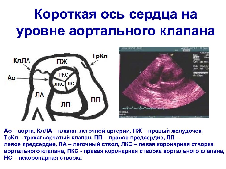 Узи коронарных артерий. Двустворчатый аортальный клапан на ЭХОКГ. Створки аортального клапана на ЭХОКГ. Короткая ось аортального клапана на ЭХОКГ. Строение аортального клапана на ЭХОКГ.