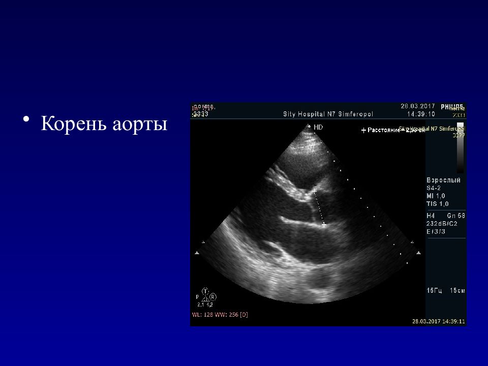 Узи аорты. Абсцесс корня аорты эхокардиография. Расширение корня аорты. Диаметр корня аорты. Корень аорты ЭХОКГ.