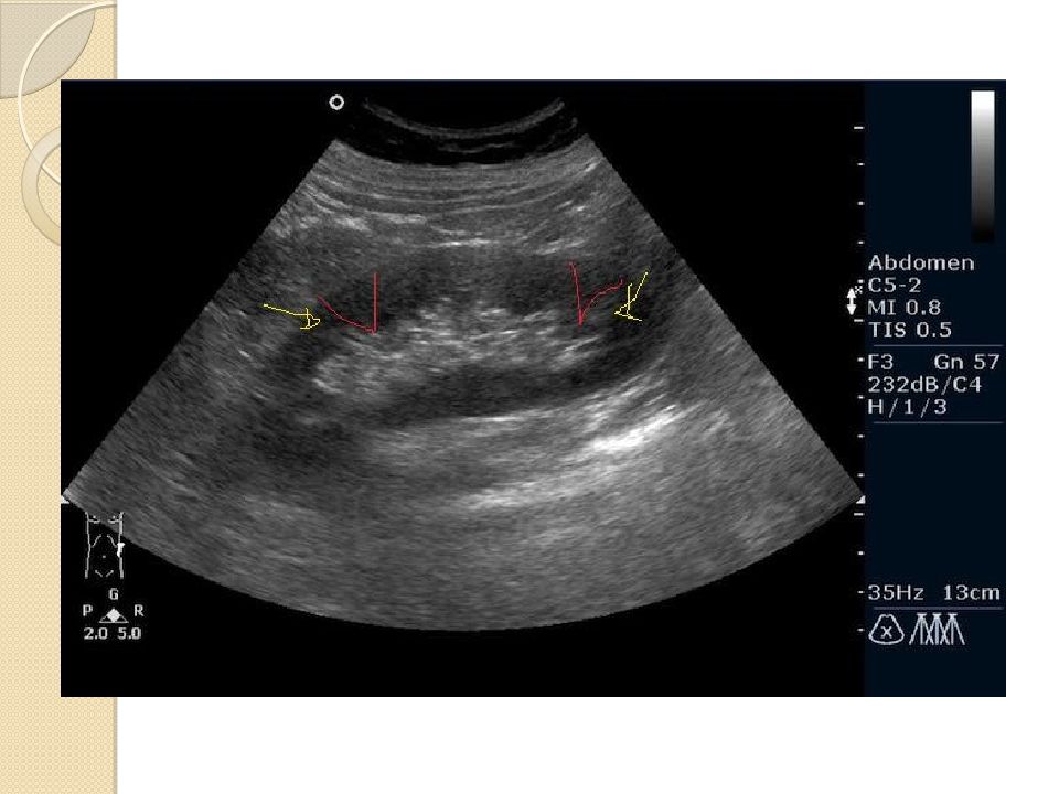 Узи почек платно. Здоровая почка на УЗИ. Снимок УЗИ здоровой почки. Объемное образование в почке на УЗИ что это. УЗИ левой почки.