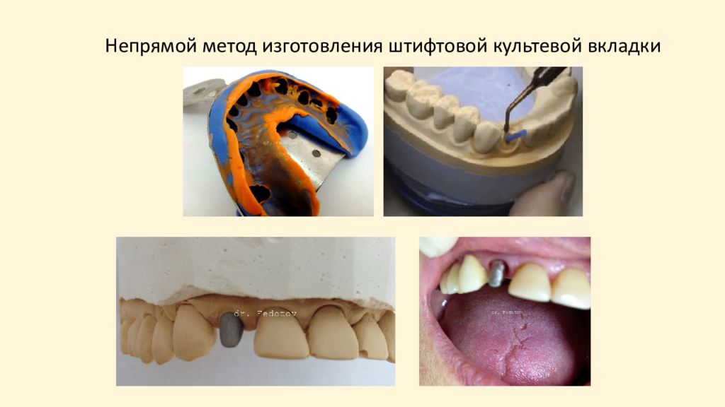 Косвенный метод изготовления вкладок презентация