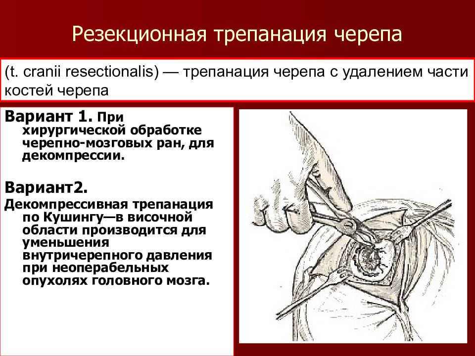 Трепанация это. Декомпрессивная Трепанация черепа по Кушингу. Резекционная Трепанация черепа по Кушингу. Декомпрессивная Трепанация черепа показания. Костно пластическая Трепанация показания.