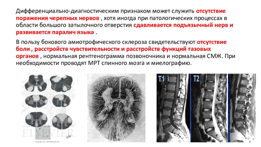 Отсутствие поражения. Поражение центрального мотонейрона. Поражение периферического мотонейрона. При поражении мотонейронов спинного мозга. Повреждение мотонейронов.