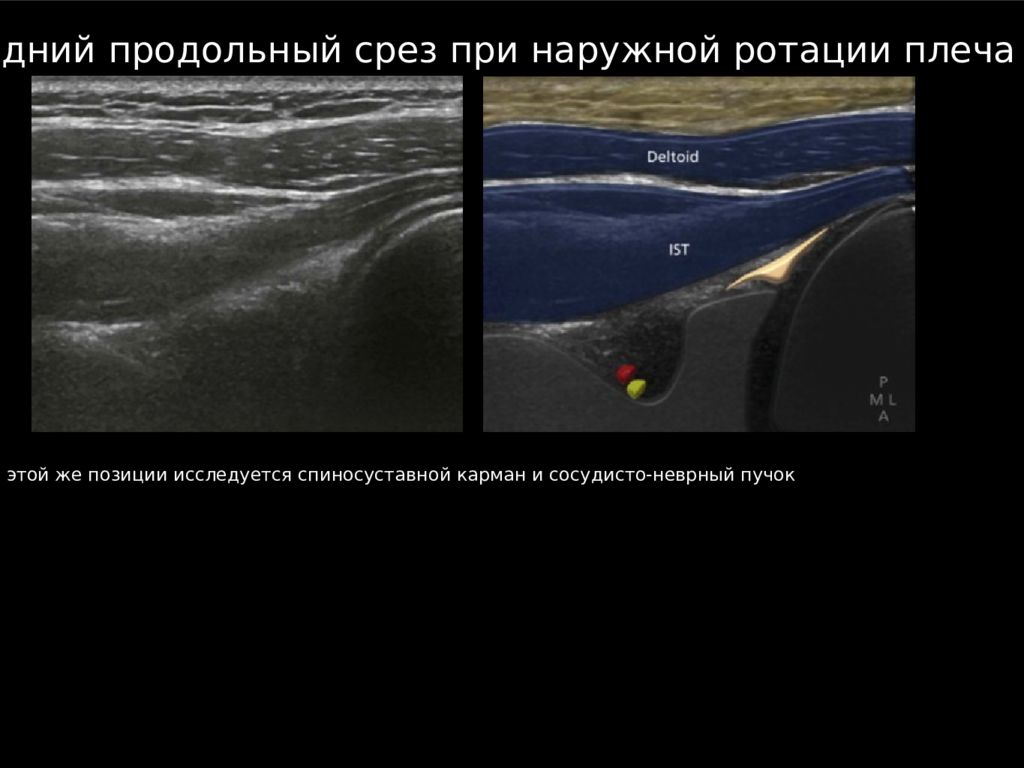 Узи плечевого. УЗИ плеча. УЗИ плечевого сустава что показывает у взрослого. Стерлитамак УЗИ плечевого сустава. УЗИ плечевого сустава в Наро-Фоминске.