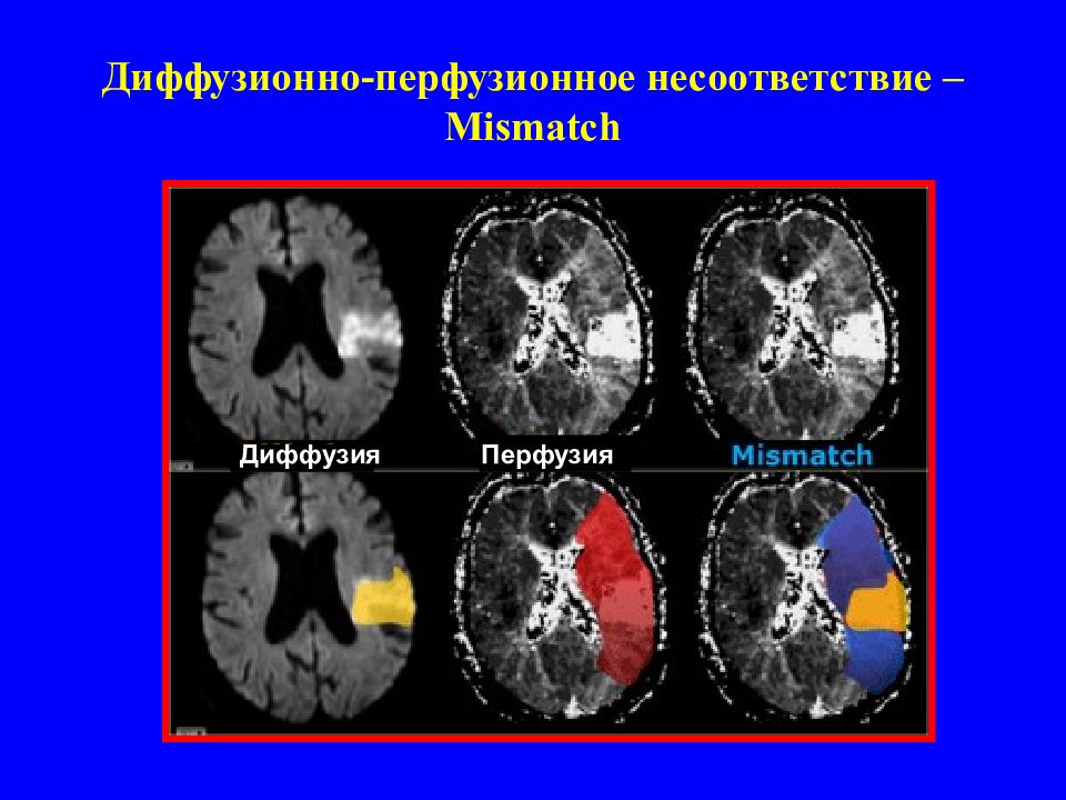 Диффузия и перфузия. Кт перфузия головного мозга. Перфузионная мрт головного мозга. Кт перфузия головного мозга при ишемическом инсульте. Мрт диффузия.