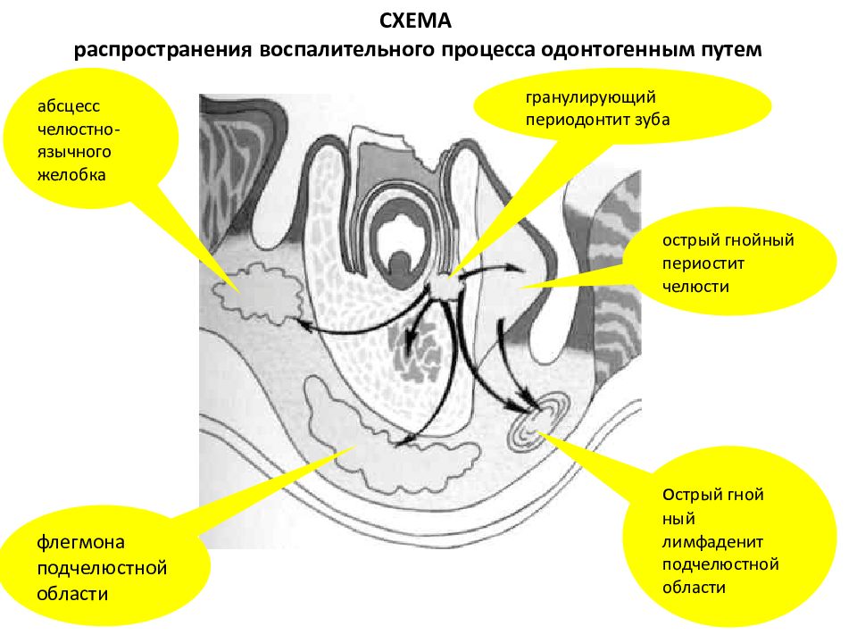 Абсцессы и флегмоны челюстно лицевой области презентация