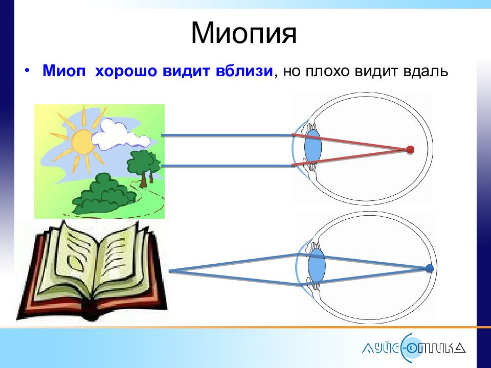 Видеть легко. Плохо вижу вдаль. Плохо вижу вблизи. Вблизи плохо вижу вдаль хорошо. Почему плохо вижу в даль.