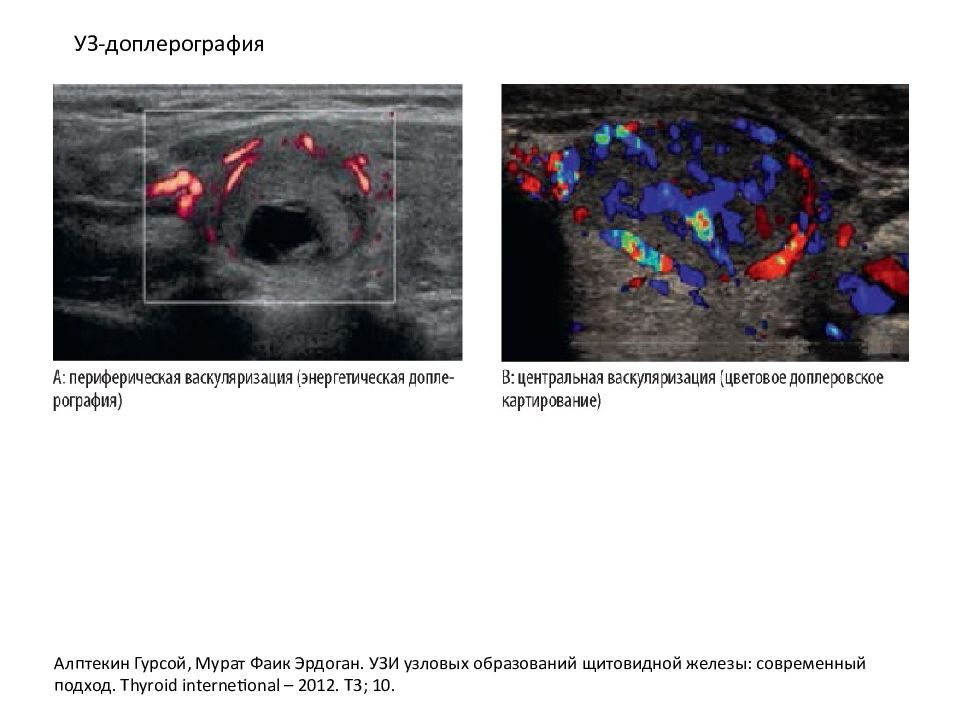 Узловые образования щитовидной железы. ЦДК гиперваскуляризация щитовидной железы. Узловые образования щитовидной железы Изранов. УЗИ васкуляризация узла щитовидной железы. Васкуляризированный узел щитовидной железы.