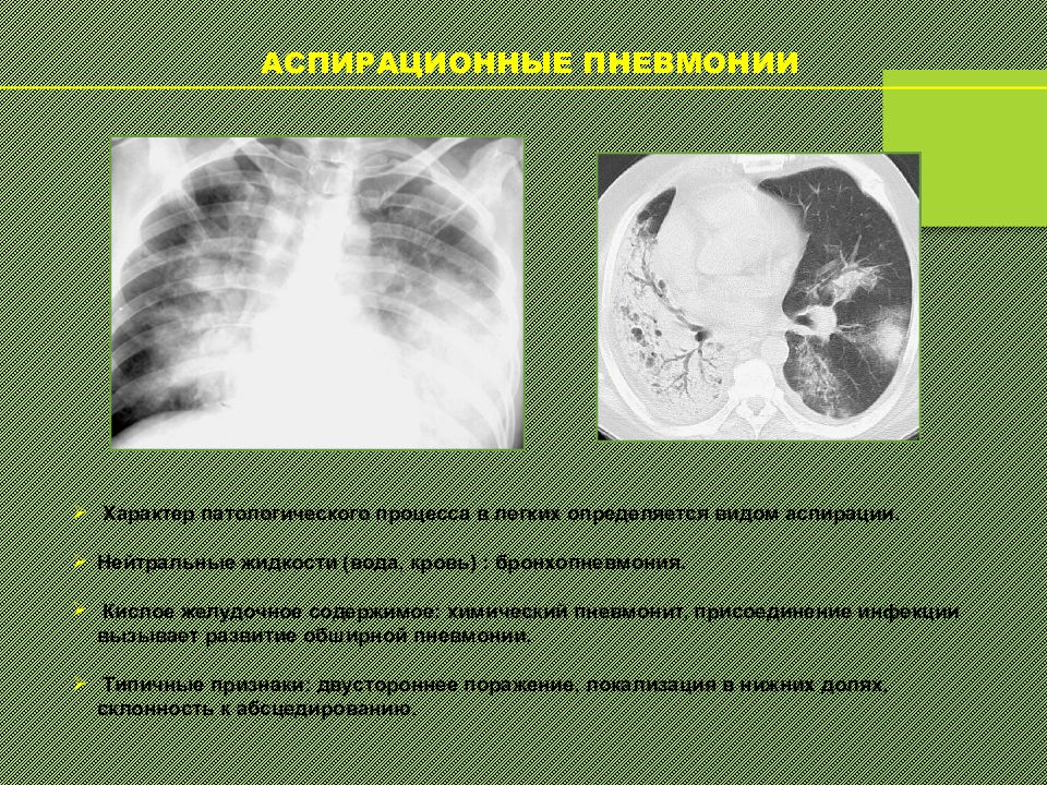 Диагностика пневмонии