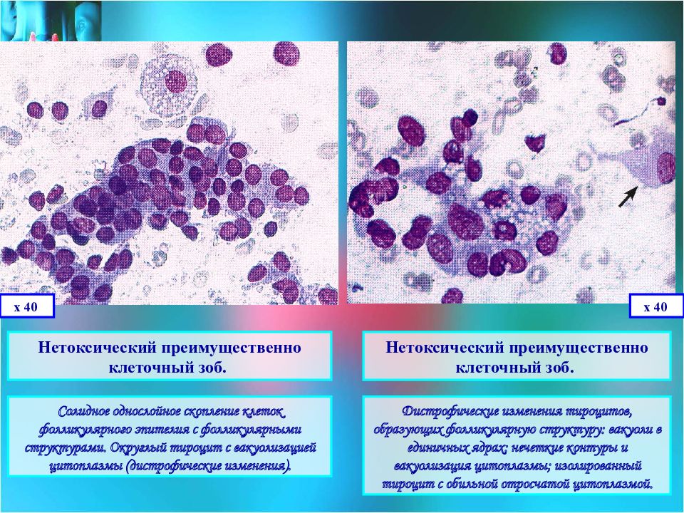Скопление клеток фолликулярного эпителия. Клеточный зоб щитовидной железы. Цитологическое исследование щитовидной железы. Вакуолизация клеток.
