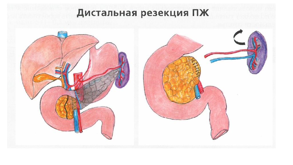 Отёк поджелудочной железы. Онкология поджелудочной железы. Энуклеация опухоли поджелудочной железы. Злокачественные новообразования хвоста поджелудочной железы.