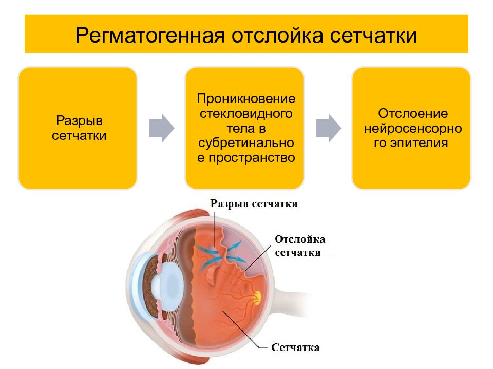 Отслойка сетчатки картинки