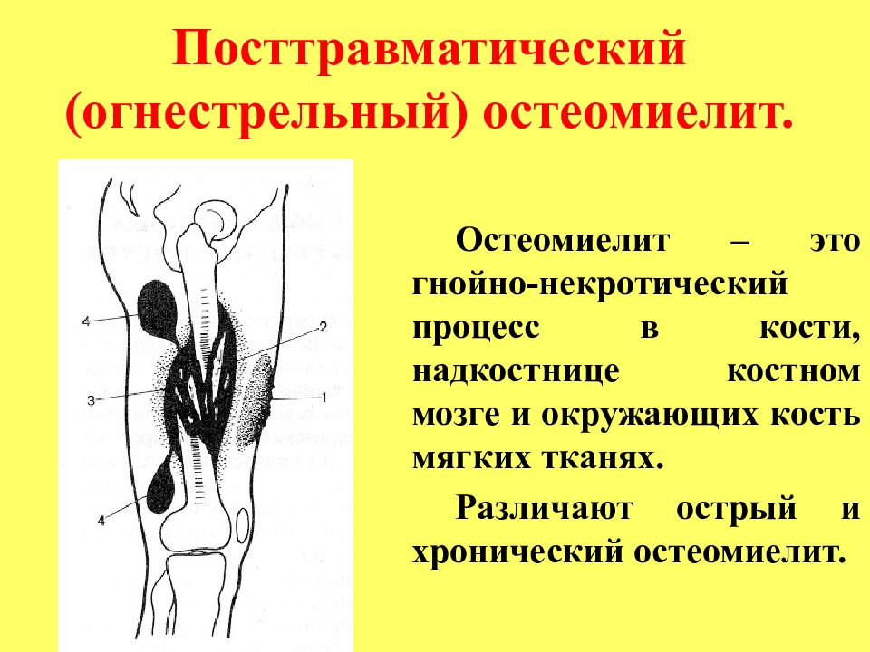 Огнестрельный остеомиелит. Травматический остеомиелит травматология. Острый посттравматический остеомиелит. Хронический посттравматический остеомиелит.