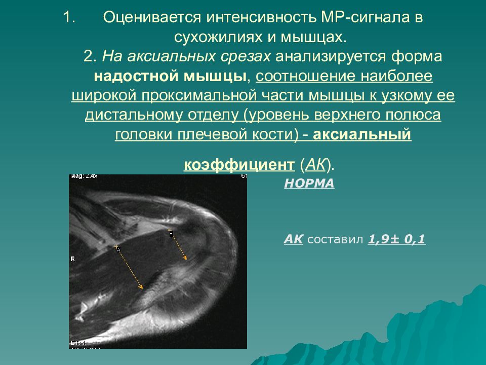 Сигнал от костного мозга неоднородный. Неоднородность МР сигнала от сухожилия надостной мышцы. Интенсивности МР сигналов на мрт. Патологический МР сигнал что это. Сухожилие надостной мышцы мрт.