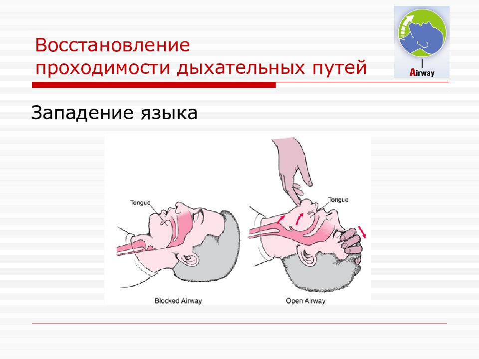 Признаки жизни и проходимости дыхательных путей. Восстановление проходимости дыхательных путей. Восстановление проходимости дыхательных путей у детей. Восстановление проходимости дыхательных путей алгоритм.