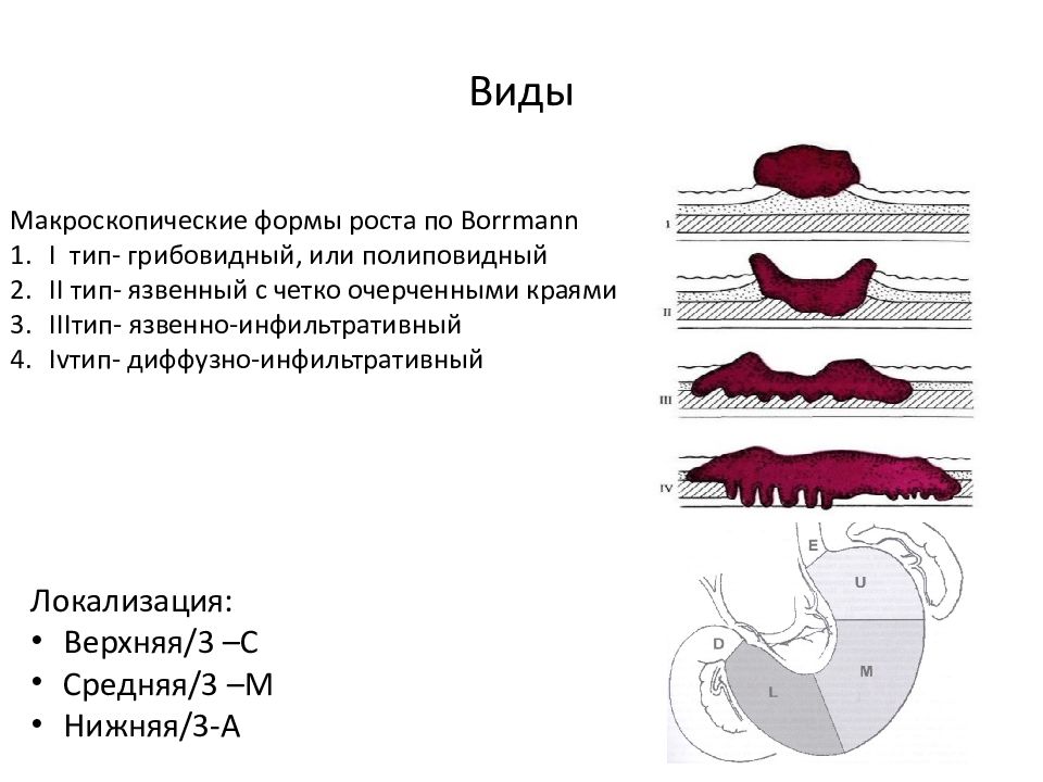 Частая локализация рака желудка. Классификация желудка. Новообразование в желудке. Опухоли желудка классификация.