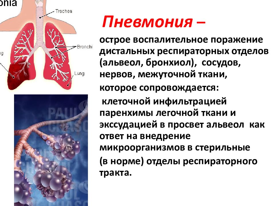 Поражение тканей легких. Пневмония воспаление легких.