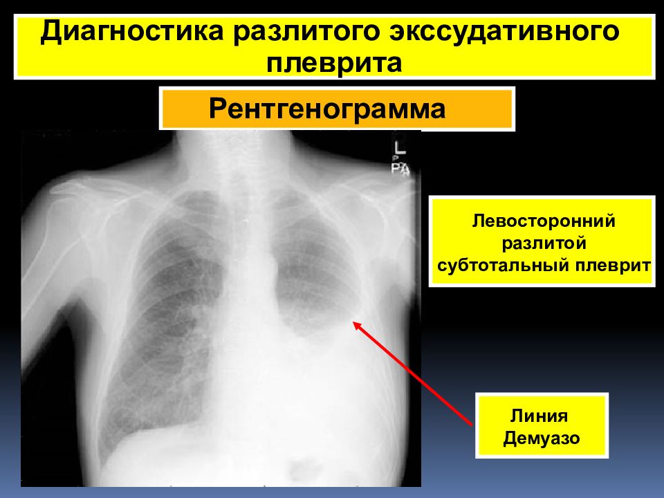 Диагноз экссудативный плеврит