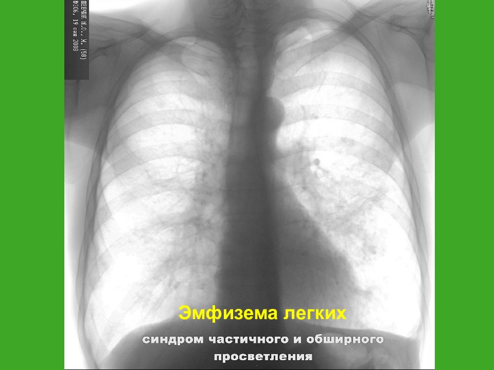 Просветление в легких. Просветление на рентгенограмме. Рентген синдромы легких. Просветление легкого на рентгене. Синдром просветления на рентгенограмме.