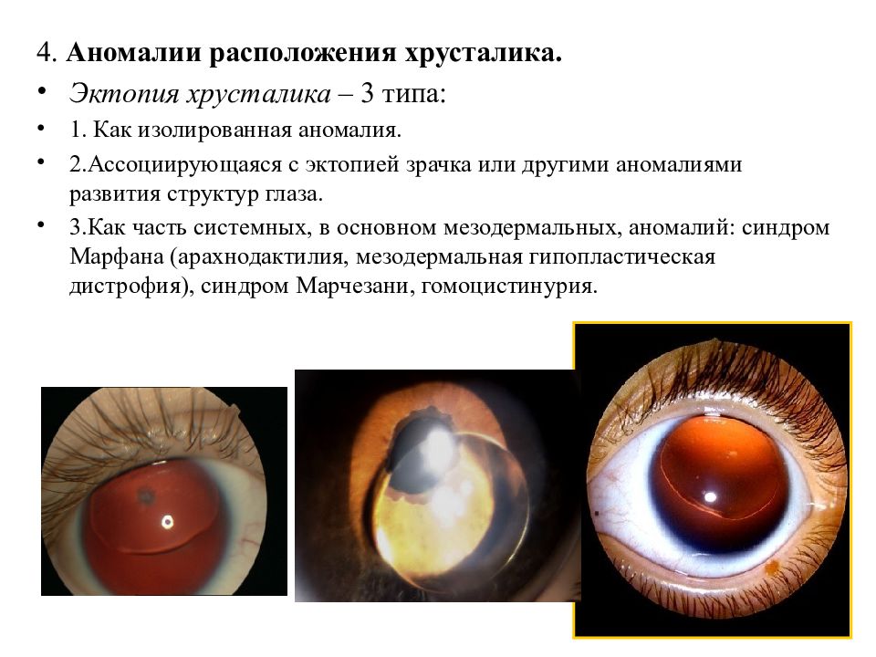 Наследственные заболевания зрения. Марфана эктопия хрусталика. Врожденная эктопия хрусталика. Синдром Марфана эктопия хрусталика. Аномалия расположения хрусталика - эктопия..
