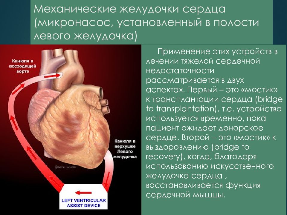 Сколько весит искусственный левый желудочек для сердца. Механические желудочки сердца. Искусственный желудочек сердца. Функции желудочков сердца. Единый желудочек сердца.