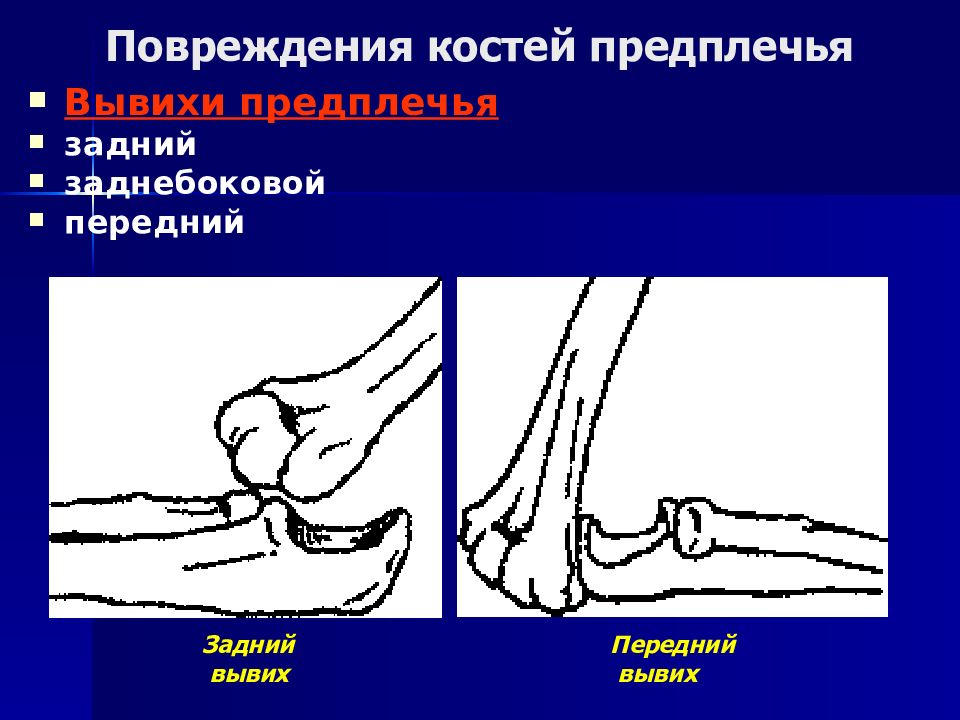 Повреждение костей. Вывих костей предплечья. Травмы костей и суставов. Травматический вывих костей предплечья.