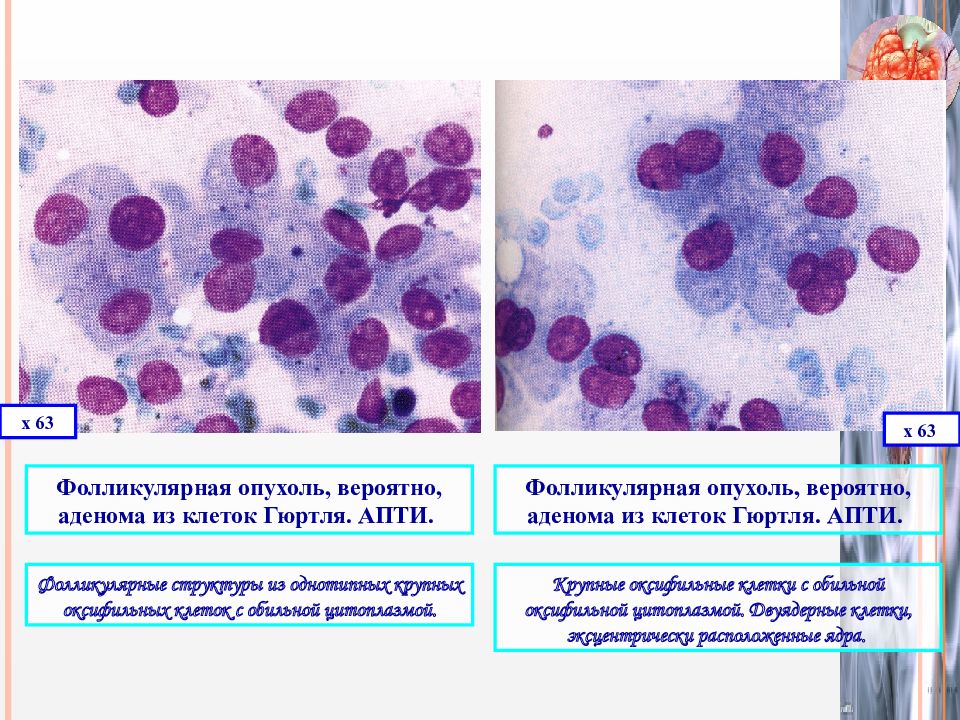 Цитологическая картина зоба с кистозной дегенерацией