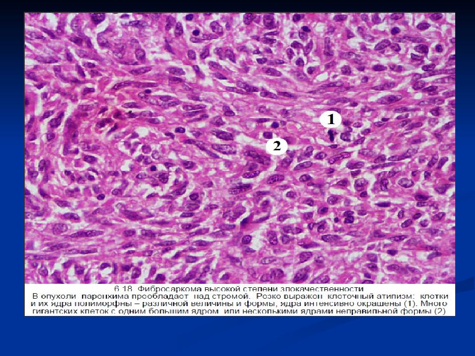 Мезенхимальные опухоли патанатомия презентация