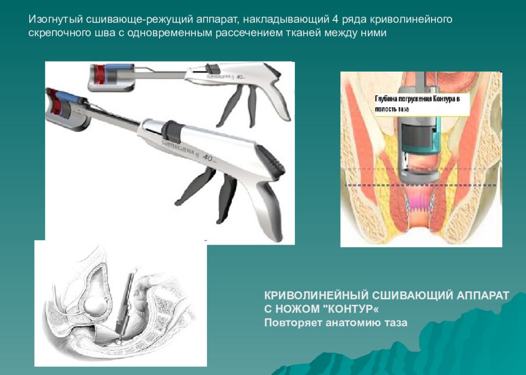 Топографическая хирургия. Сшивающие аппараты в хирургии. Сшивающие аппараты в хирургии презентация. Линейно режущие сшивающие аппараты. Сшивающий аппарат каттеры.