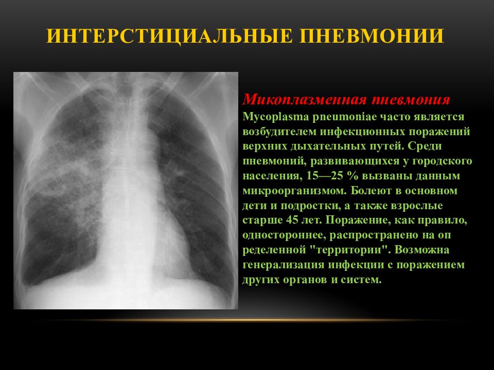 Микоплазменная пневмония симптомы у взрослых. Интерстициальная пневмония рентген. Микоплазменная пневмония рентгенограмма. Интерстициальная пневмония рентген картина. Интерстициальная пневмония рентген заключение.