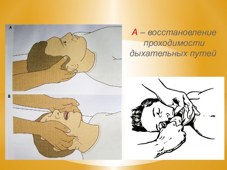 Восстановление проходимости дыхательных. Восстановление непроходимости дыхательых путей. Восстановление проходимости дыхательных путей. Постановление проходимости дыхательных путей. Запрокидывание головы пострадавшего.