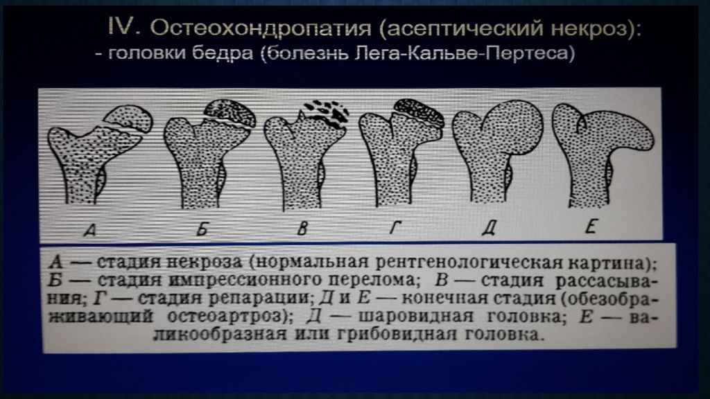 Асептический бедренной кости. Степени асептического некроза головки бедренной кости на кт. Классификация асептического некроза головки бедренной кости. Исход асептического некроза головки бедренной кости кт. Асептический некроз головки бедренной кости стадии рентген.