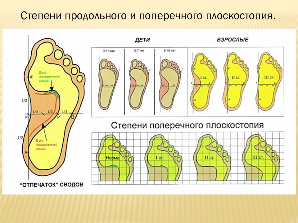 Виды плоскостопия фото