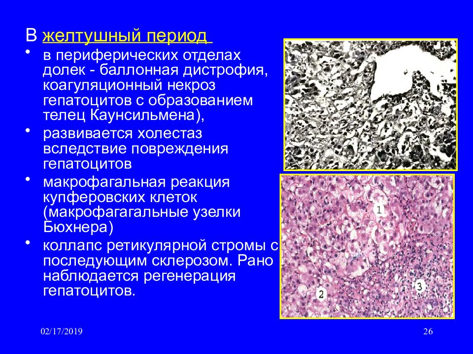 Процесс сопровождающийся накоплением в цитоплазме гепатоцитов. Коагуляционный некроз почки микропрепарат. Коагуляционный некроз микропрепарат. Вакуольная дистрофия гепатоцитов. Гидропическая дистрофия печени.