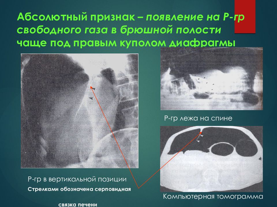 Полость часто. Свободный ГАЗ В брюшной полости причины. Свободный ГАЗ В брюшной полости на УЗИ. Выпот в брюшной полости кт. Экссудат в брюшной полости.