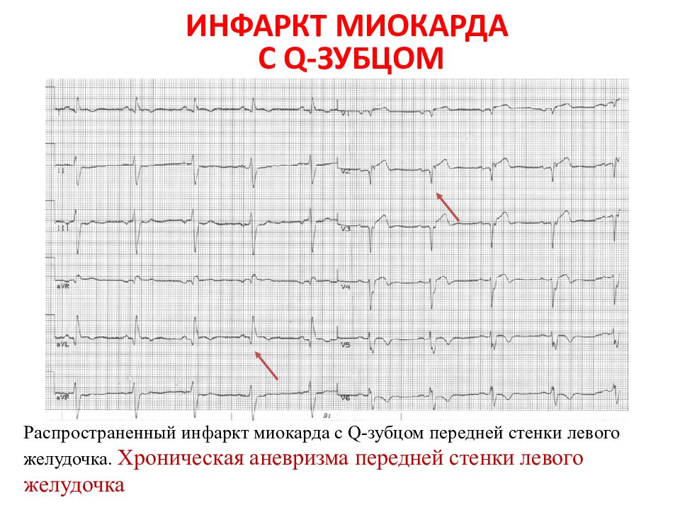 Ибс стенокардия инфаркт миокарда презентация