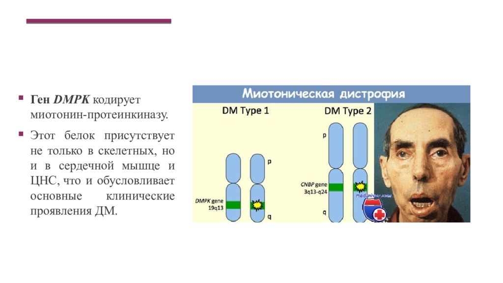 Гена тип. Куршмана Баттена Штейнерта. Миотонии Россолимо–Штейнерта–Куршмана. Миотония Штейнерта Баттена.