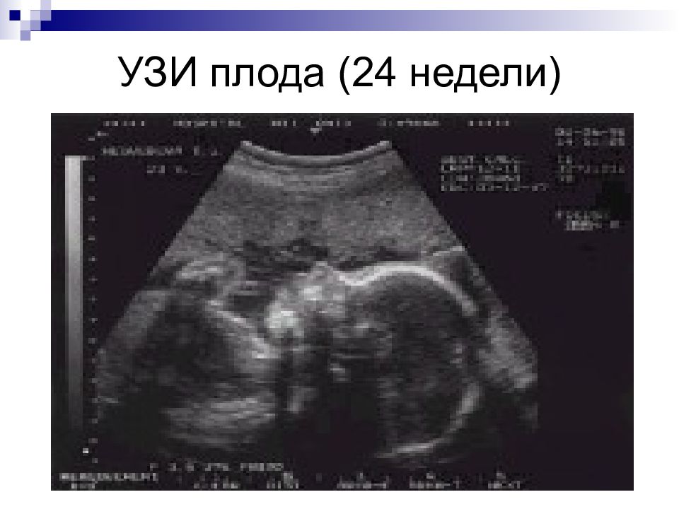 Плохое узи. УЗИ 24 недели беременности. Плод на 24 неделе беременности УЗИ. УЗИ по беременности в 24 недели. УЗИ плода 24 недели нормы.